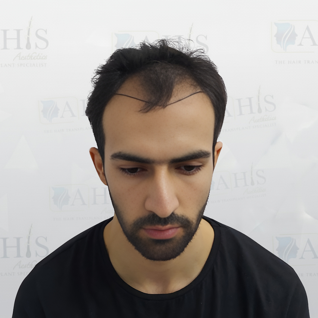Receding hairline — before hair transplant at AHIS Aesthetics Mysore