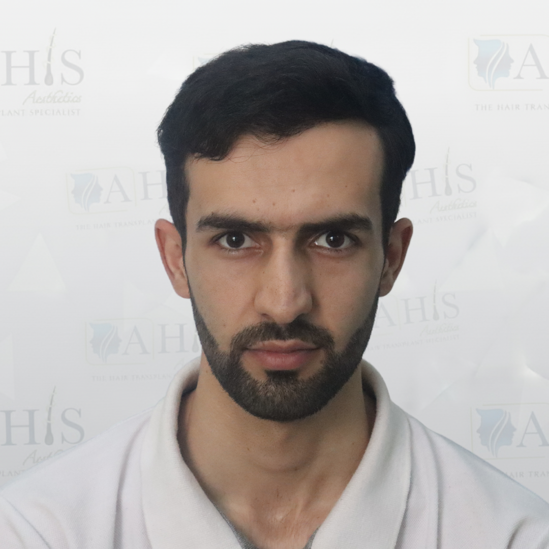 Receding hairline — after hair transplant at AHIS Aesthetics Mysore